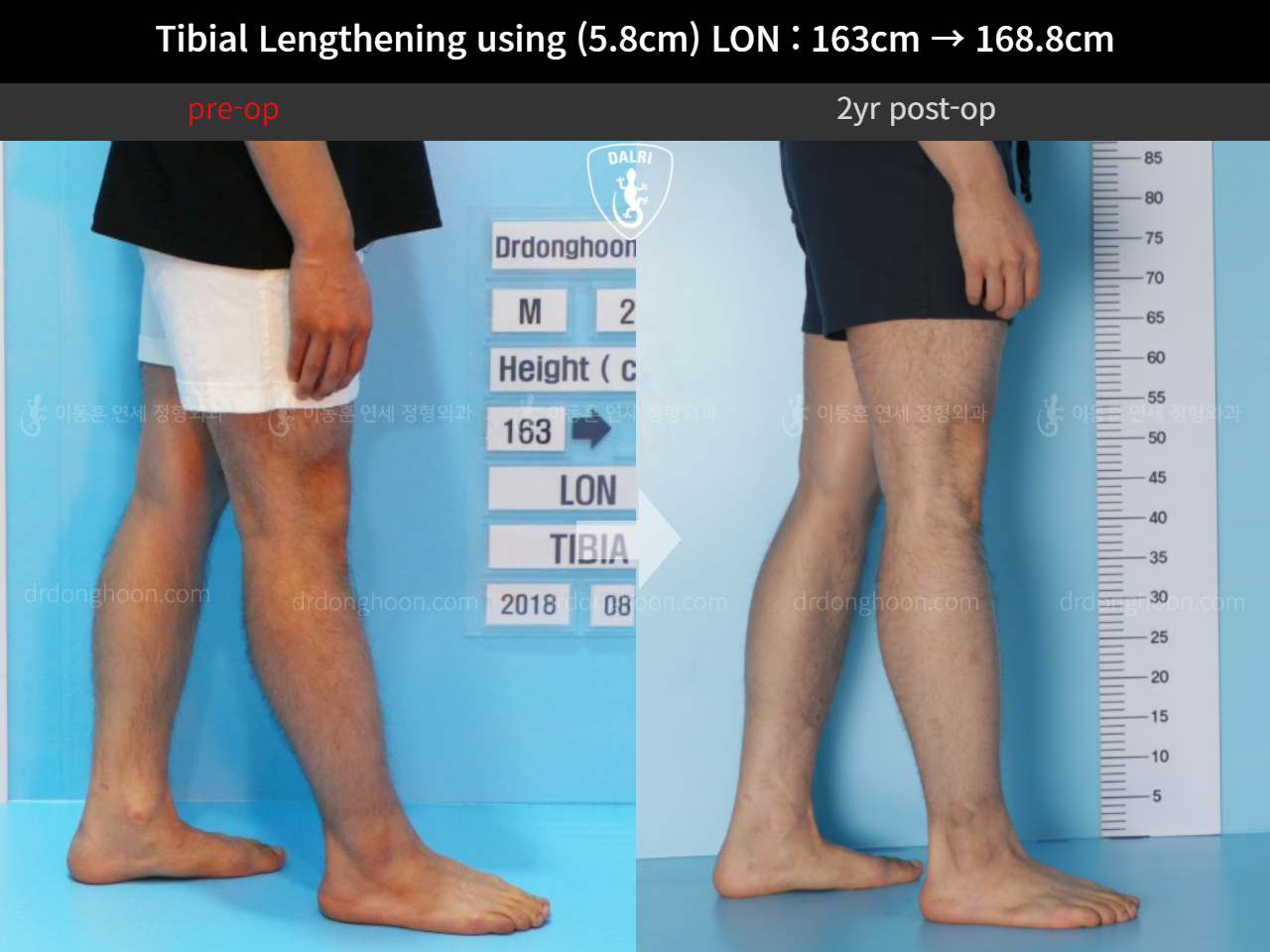 Before and after cll lon, case 11468172, image 8, Dr. Donghoon institute (DALRI)
