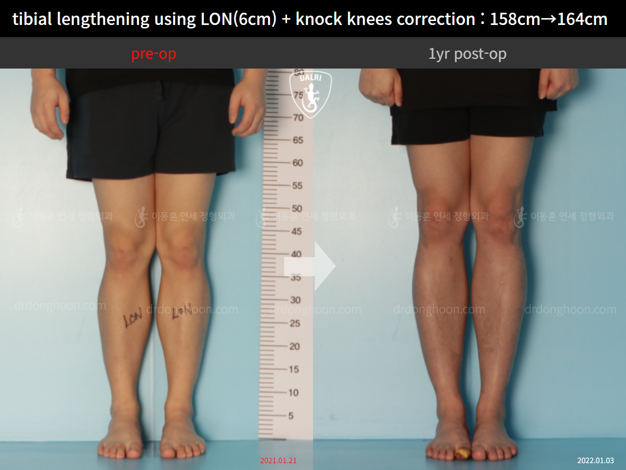 Before and after cll + deformity correction, case 9324521, image 5, Dr. Donghoon institute (DALRI)
