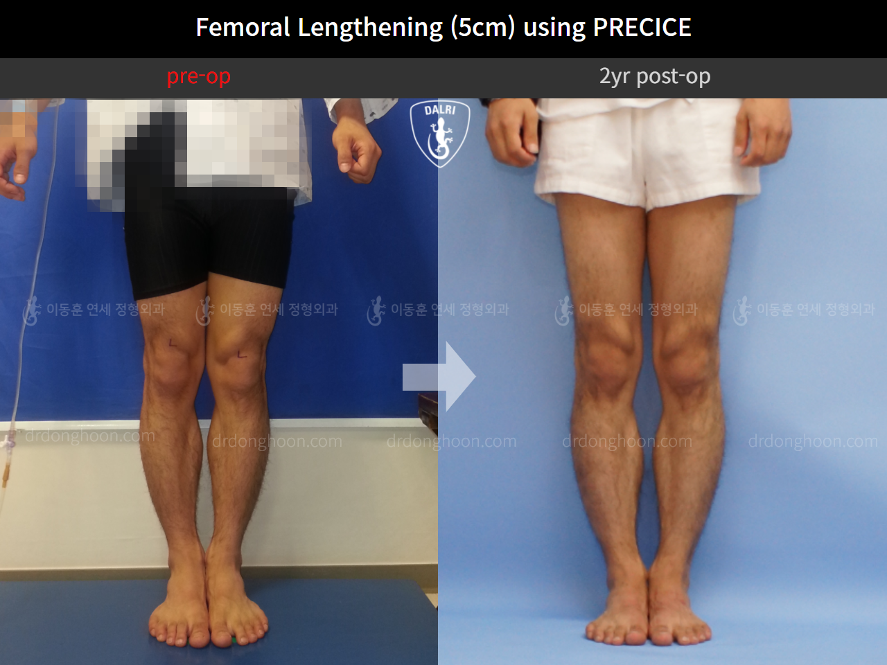 Before and after cll precice, case 4323372, image 4, Dr. Donghoon institute (DALRI)