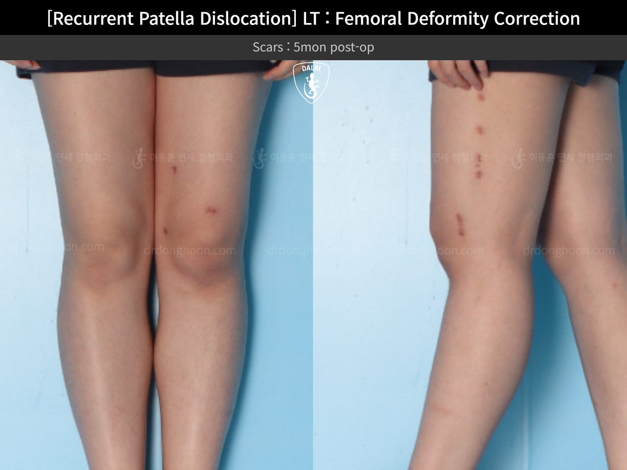 Before and after recurrent patella dislocation, case 13337596, image 6, Dr. Donghoon institute (DALRI)