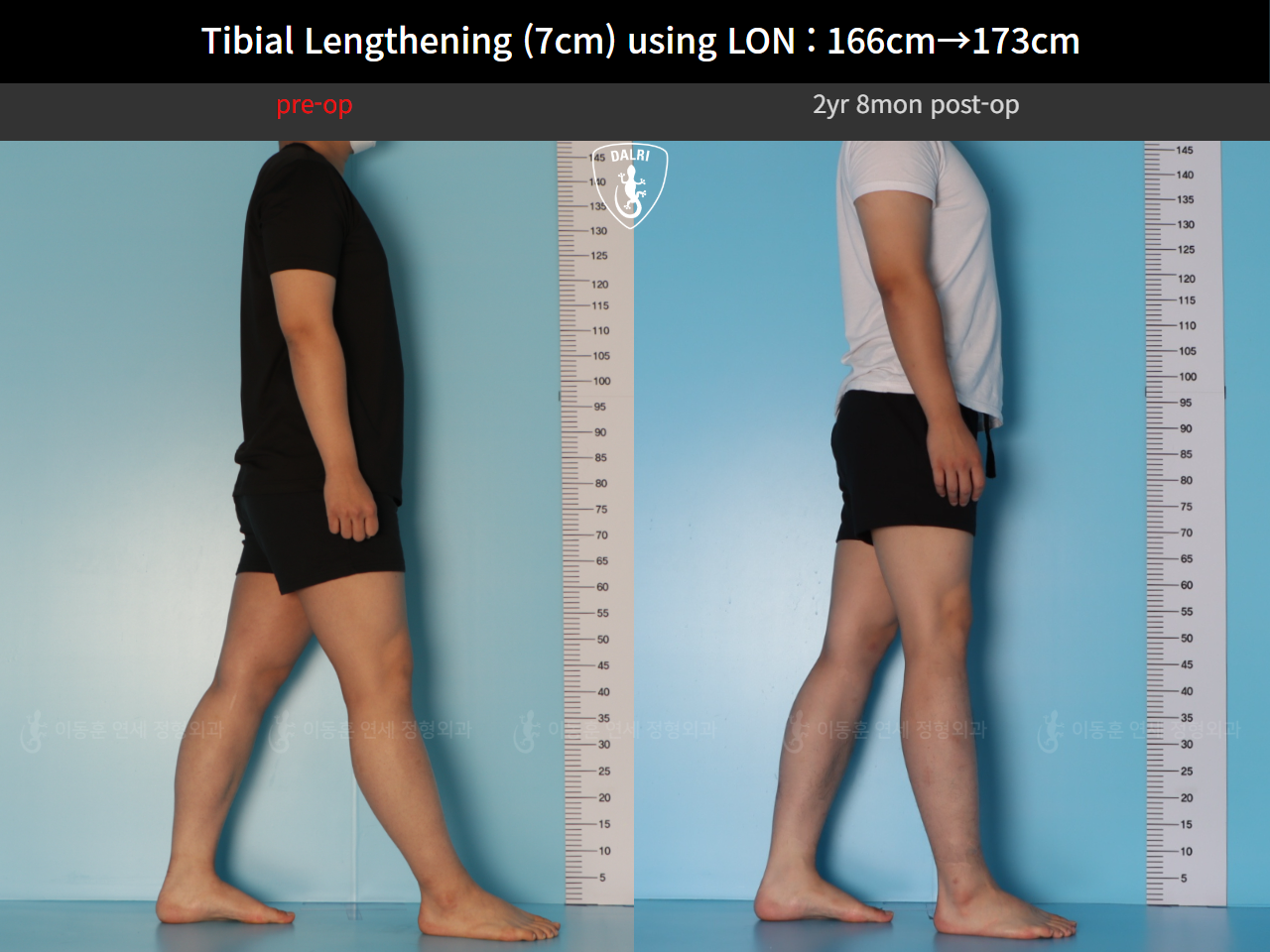 Before and after cll lon, case 127679780, image 4, Dr. Donghoon institute (DALRI)