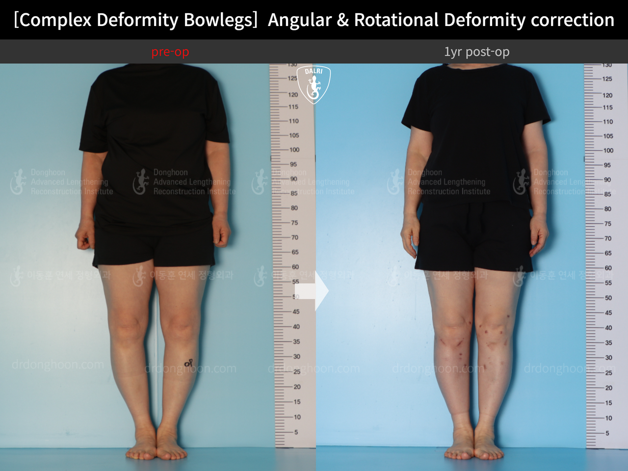 Before and after adult bowlegs, case 14378683, image 1, Dr. Donghoon institute (DALRI)