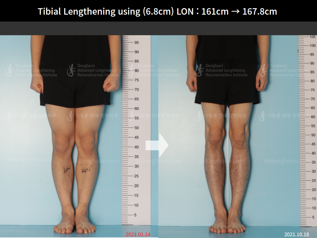 Before and after cll lon, case 8663720, image 5, Dr. Donghoon institute (DALRI)