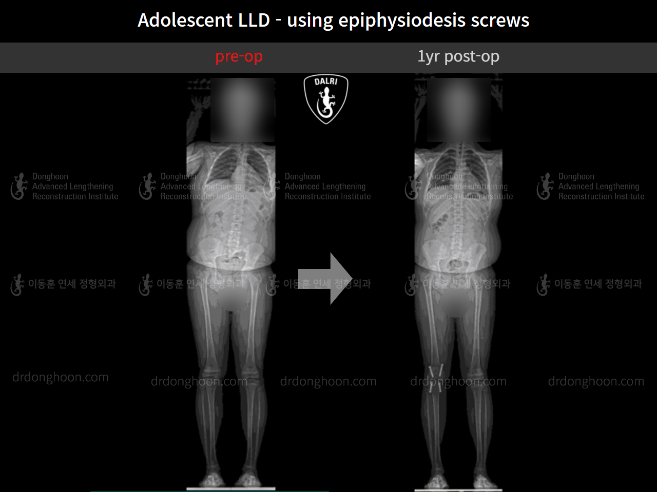 Before and after paediatric & adolescent lld, case 10291768, image 6, Dr. Donghoon institute (DALRI)