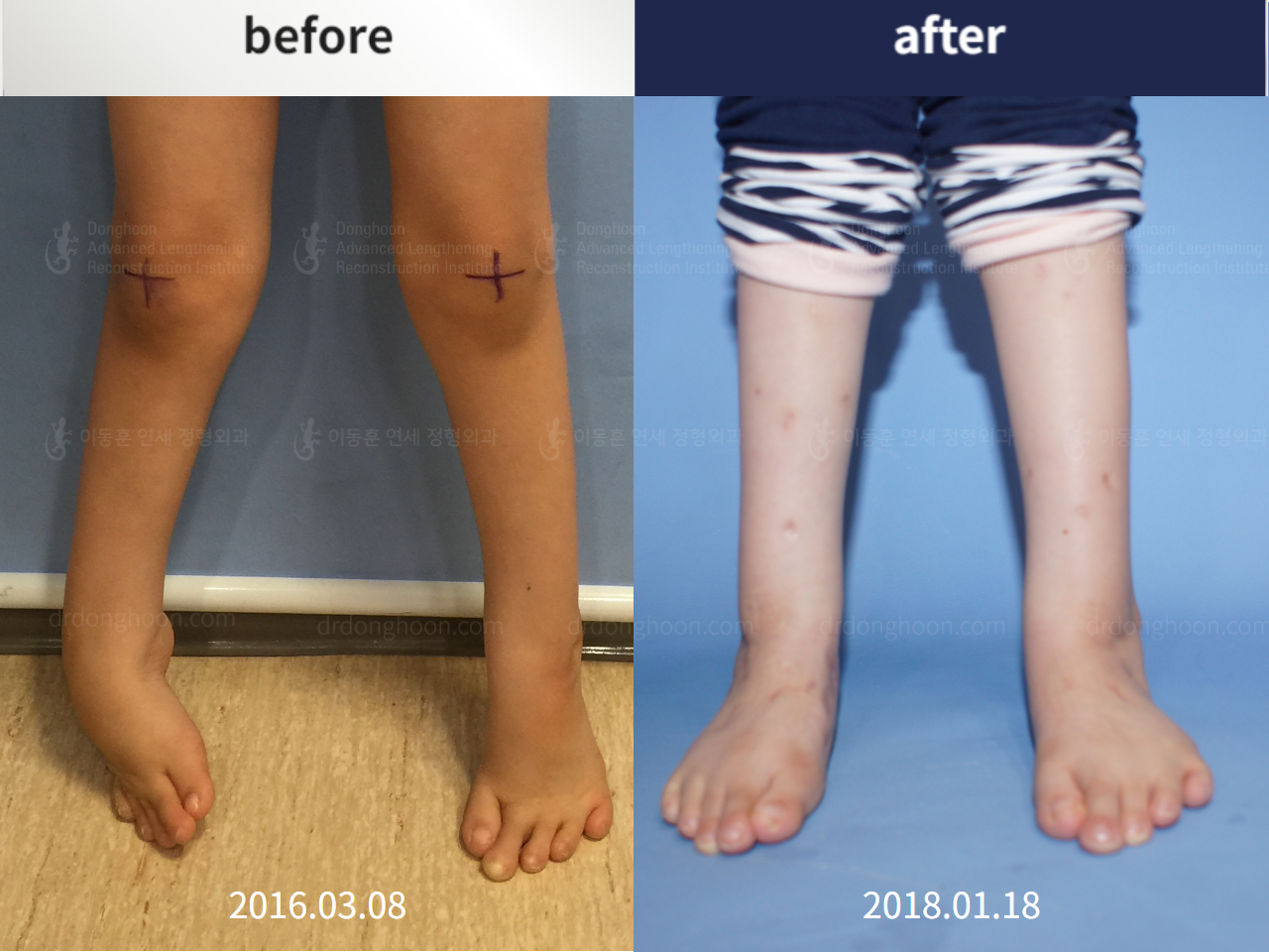 Before and after congenital clubfoot, case 4233843, image 3, Dr. Donghoon institute (DALRI)