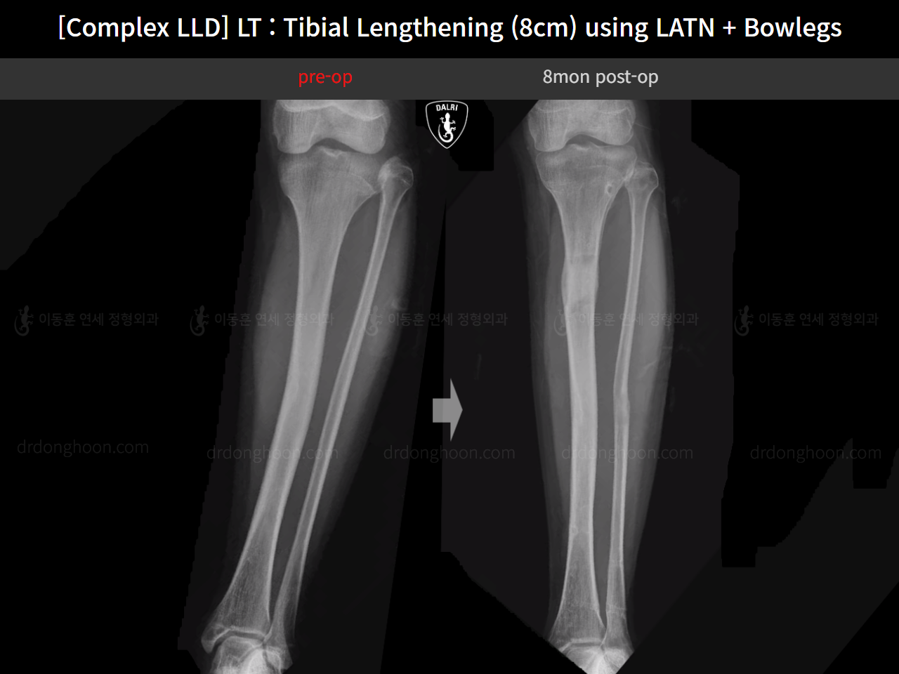 Before and after adult lld, case 16724300, image 10, Dr. Donghoon institute (DALRI)