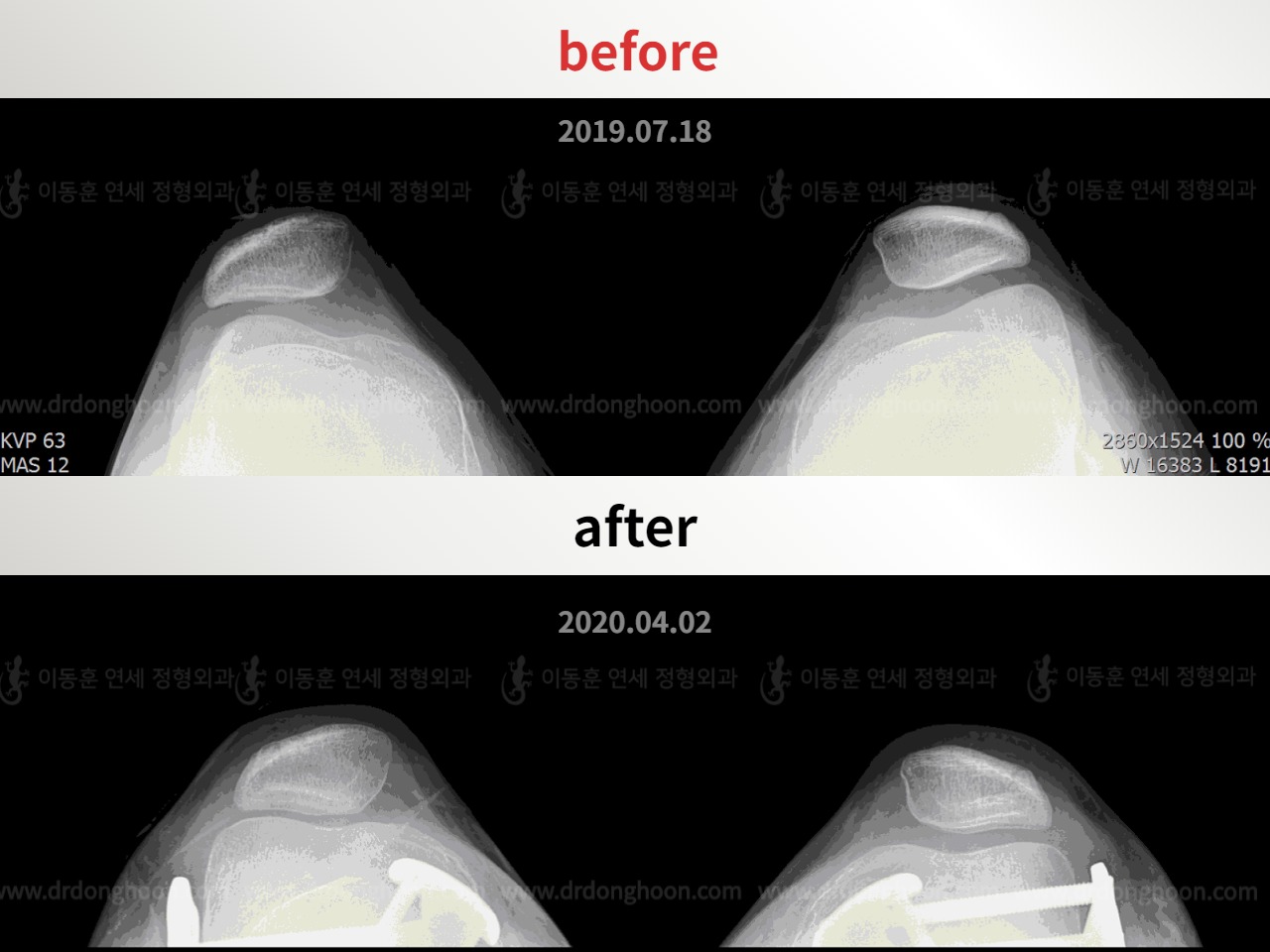 Before and after recurrent patella dislocation, case 4594124, image 1, Dr. Donghoon institute (DALRI)