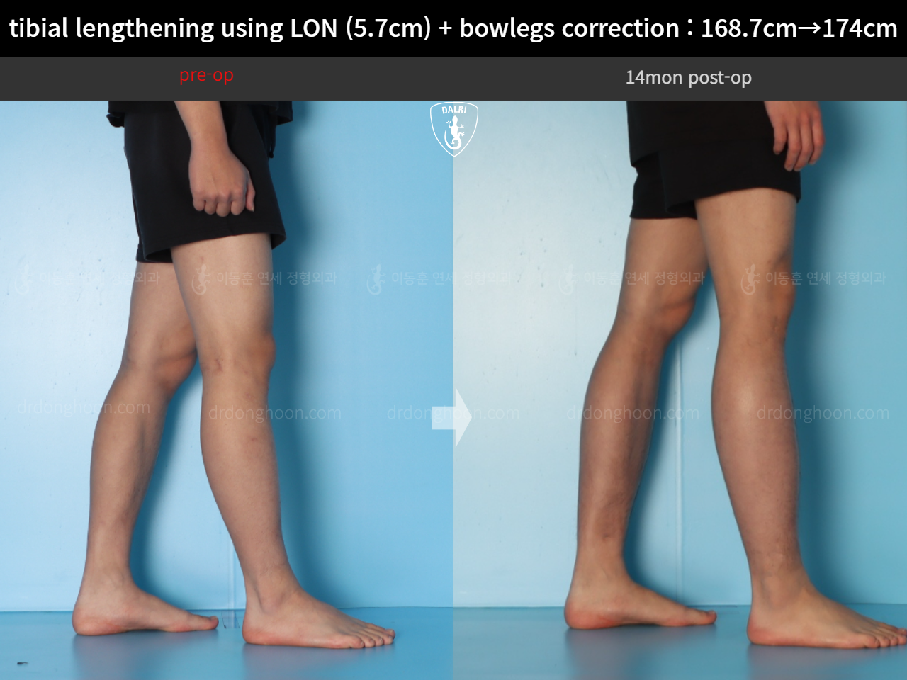 Before and after cll + deformity correction, case 18160780, image 9, Dr. Donghoon institute (DALRI)