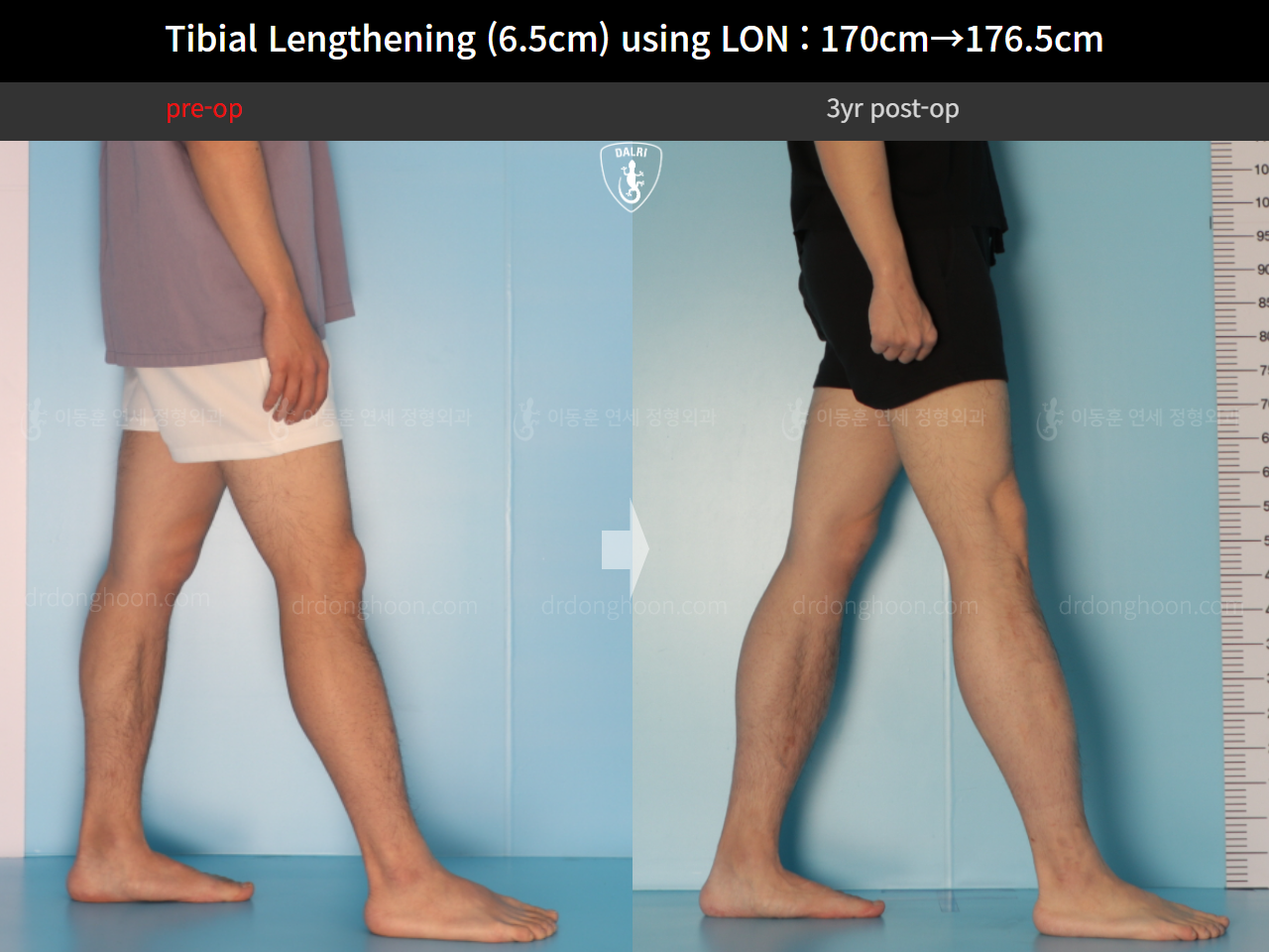 Before and after cll lon, case 16299082, image 8, Dr. Donghoon institute (DALRI)