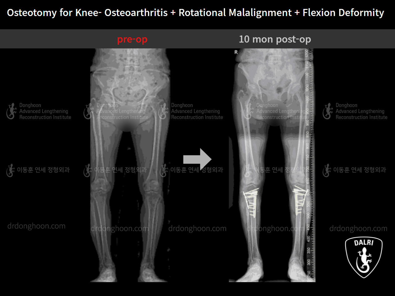 Before and after osteotomy for knee osteoarthritis, case 9128503, image 10, Dr. Donghoon institute (DALRI)