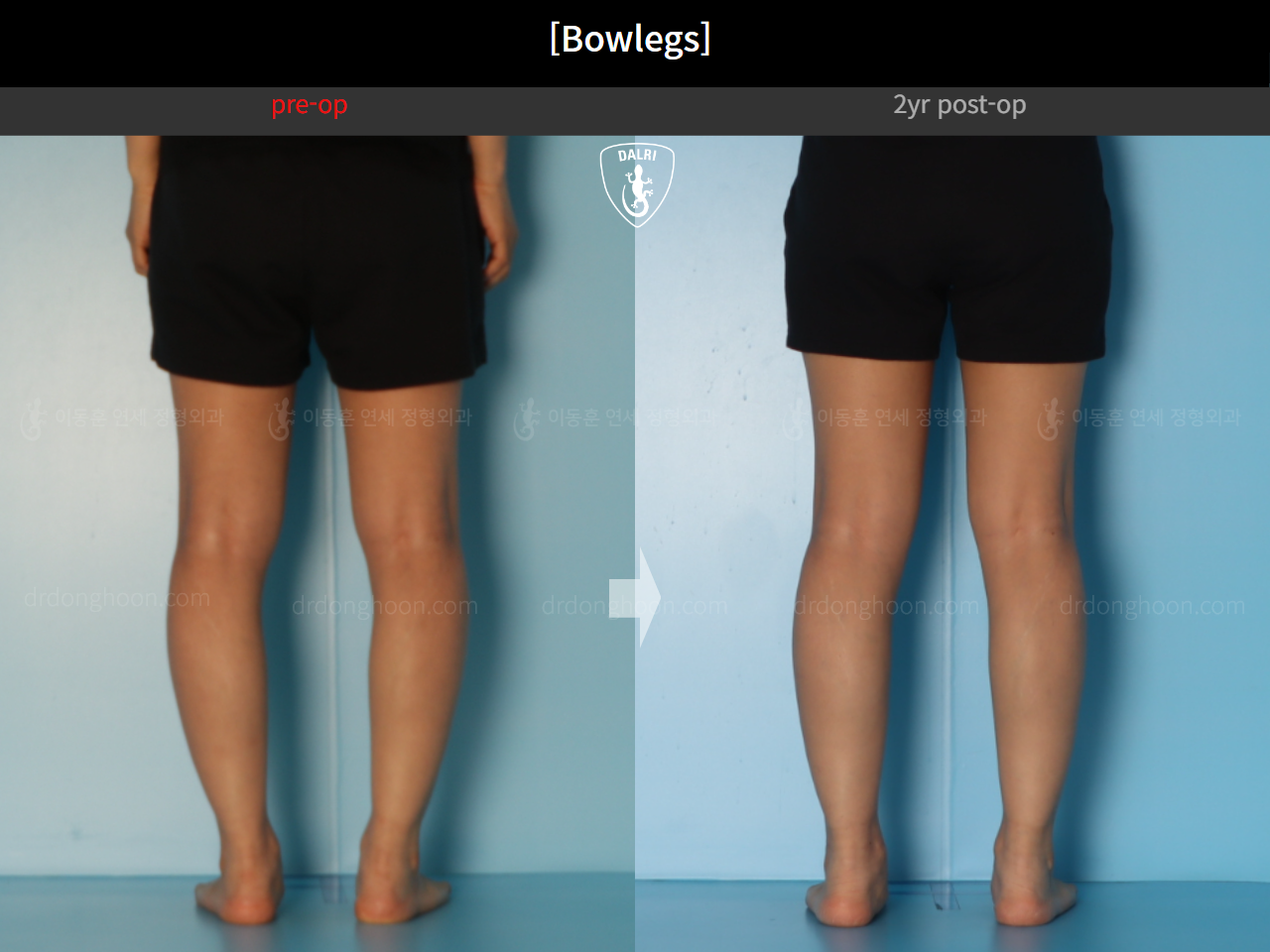 Before and after adult bowlegs, case 20942169, image 10, Dr. Donghoon institute (DALRI)