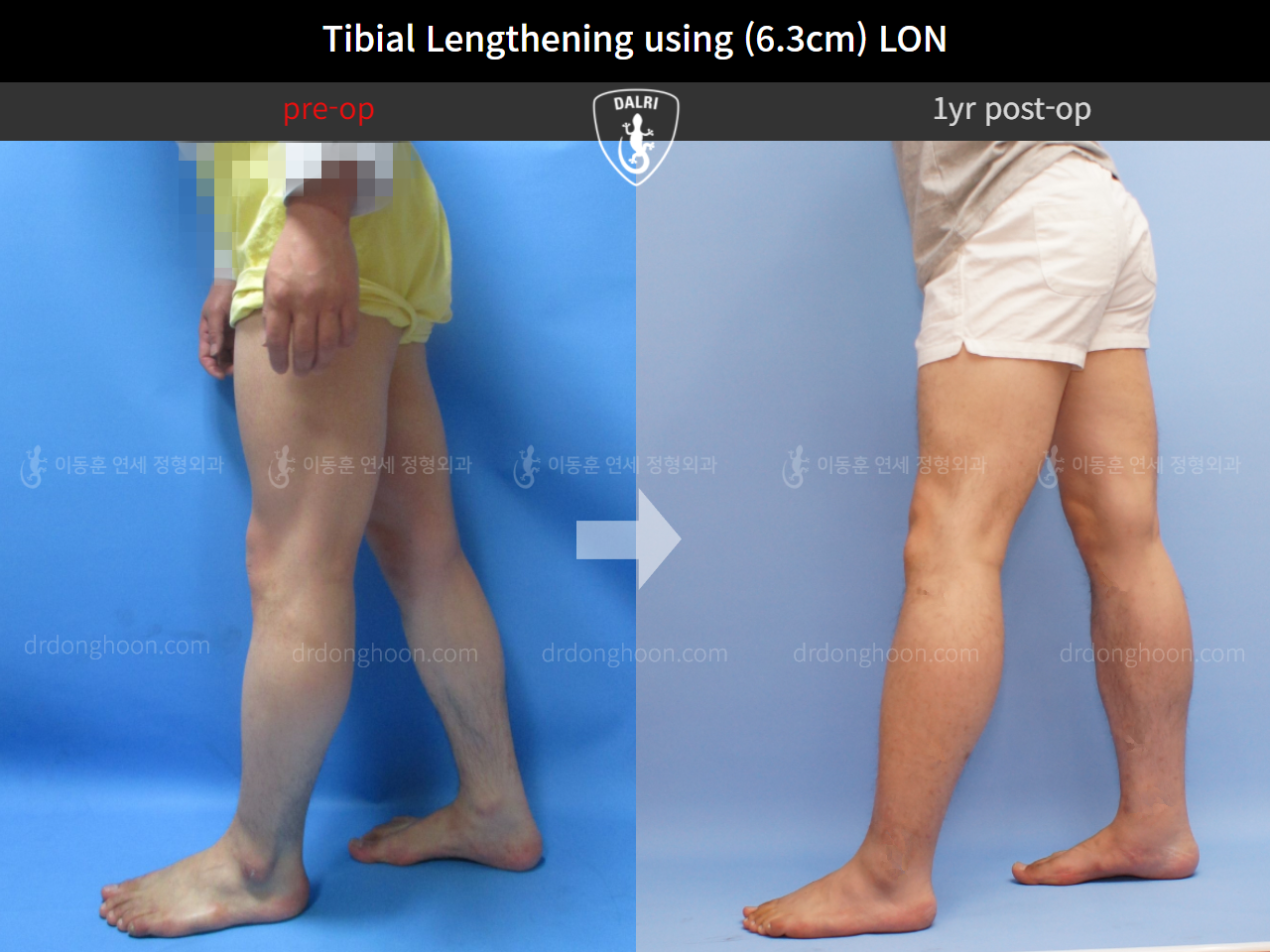 Before and after cll lon, case 4577838, image 4, Dr. Donghoon institute (DALRI)