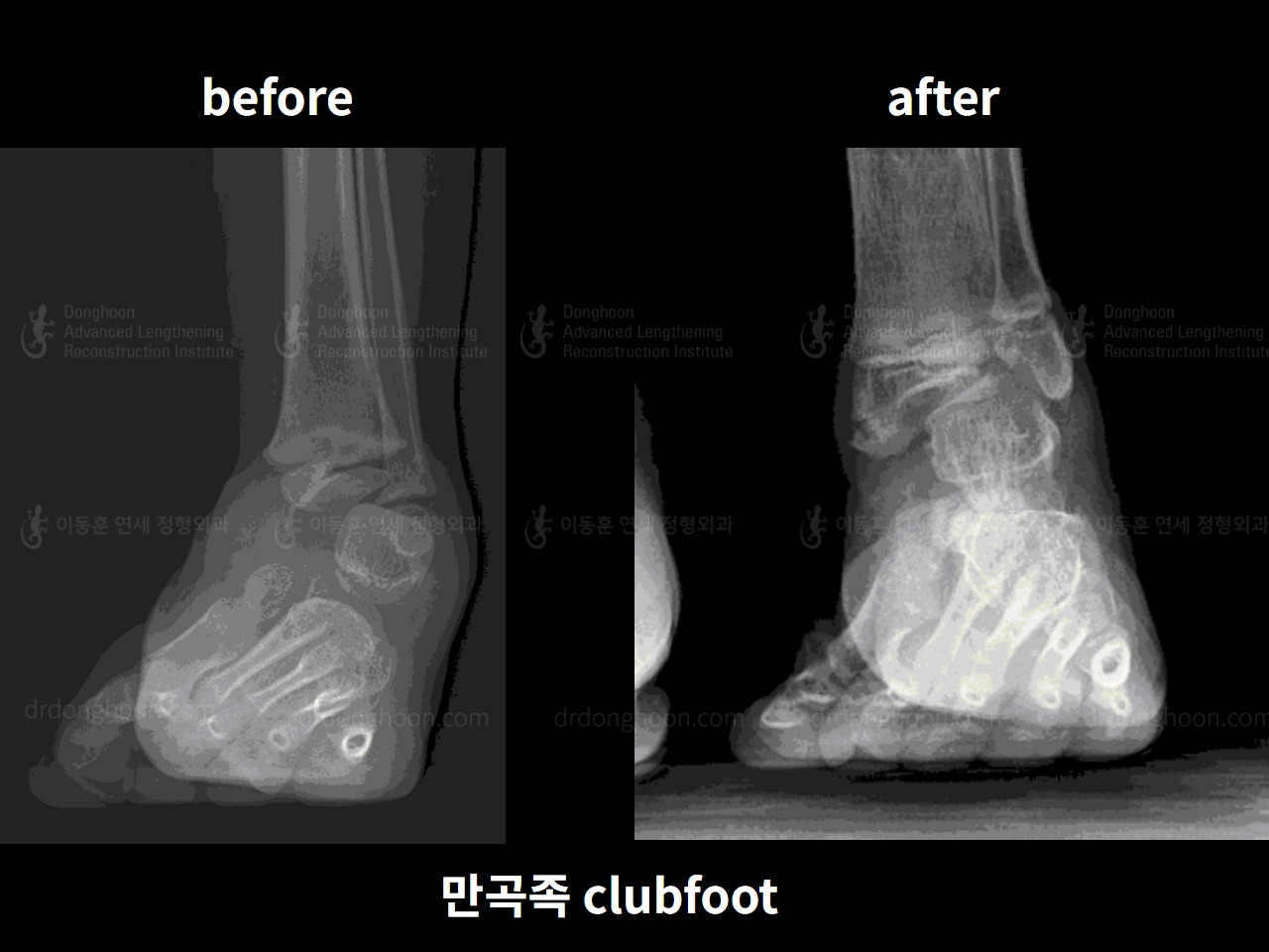 Before and after paediatric congenital condition, case 4304763, image 4, Dr. Donghoon institute (DALRI)