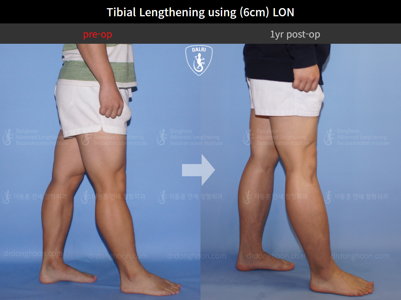 Before and after cll lon, case 4323461, image 8, Dr. Donghoon institute (DALRI)