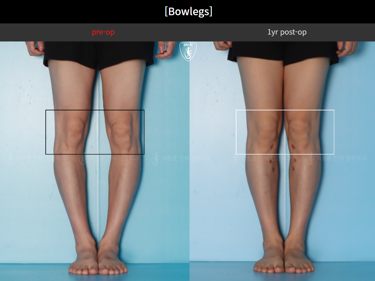 Before and after adult bowlegs, case 125438866, image 8, Dr. Donghoon institute (DALRI)