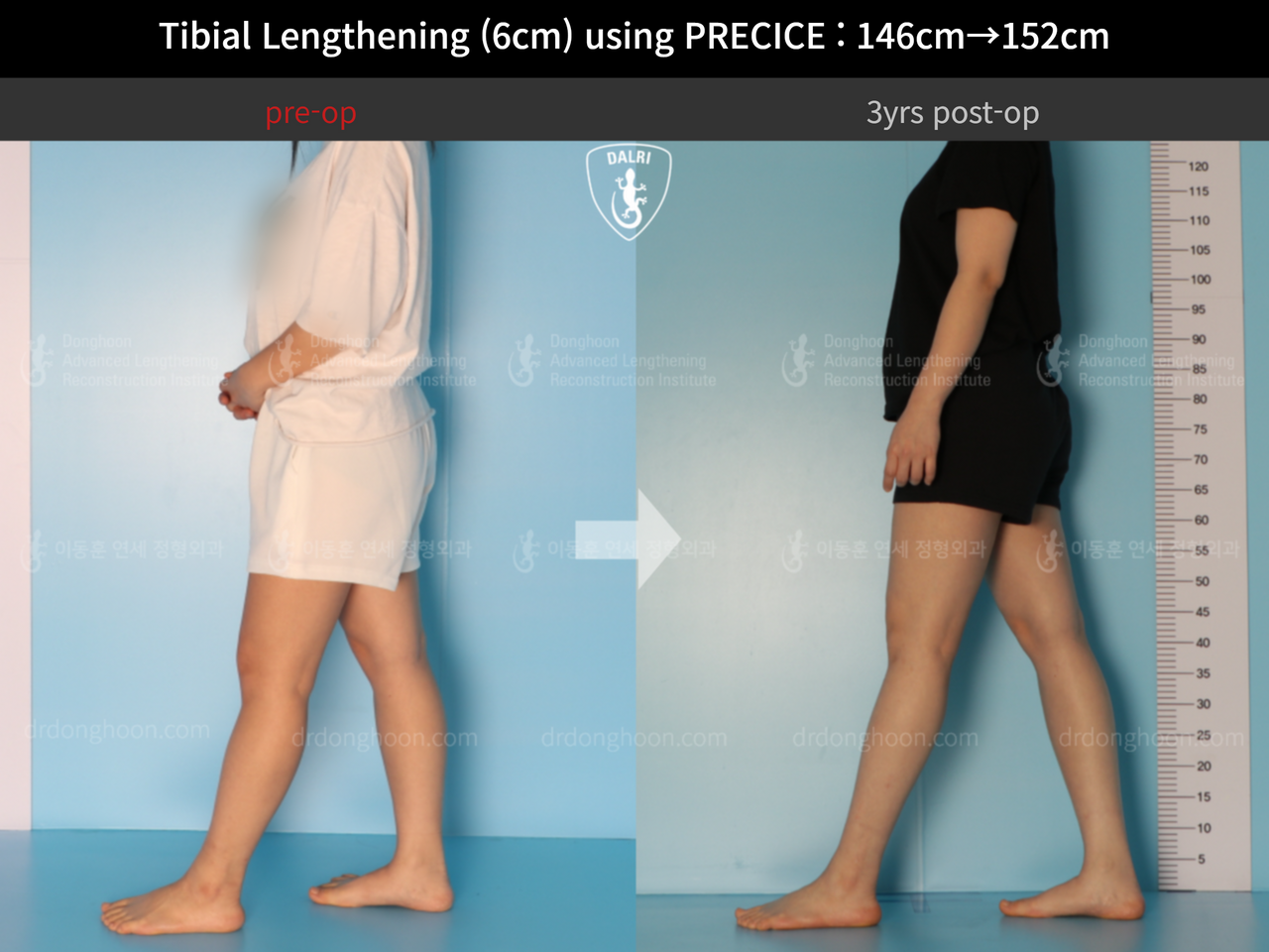 Before and after cll precice, case 4573599, image 3, Dr. Donghoon institute (DALRI)