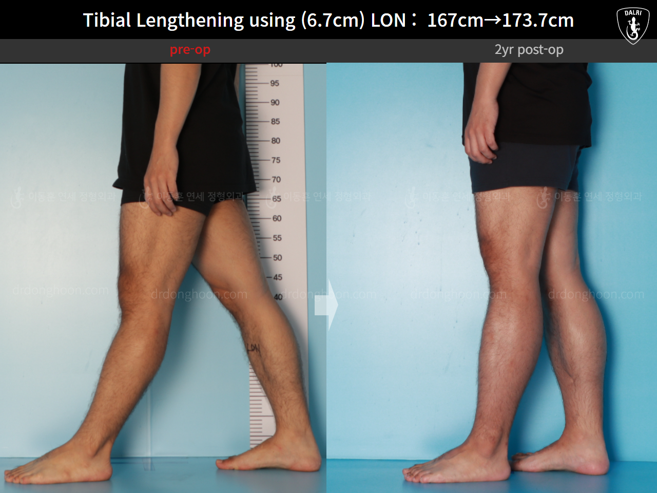Before and after cll lon, case 16165376, image 9, Dr. Donghoon institute (DALRI)