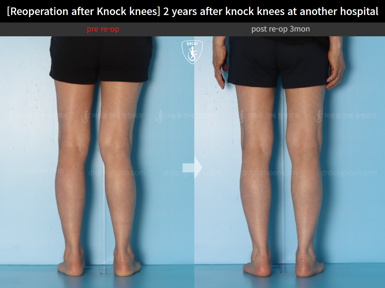 Before and after reoperation after deformity correction, case 15622876, image 10, Dr. Donghoon institute (DALRI)