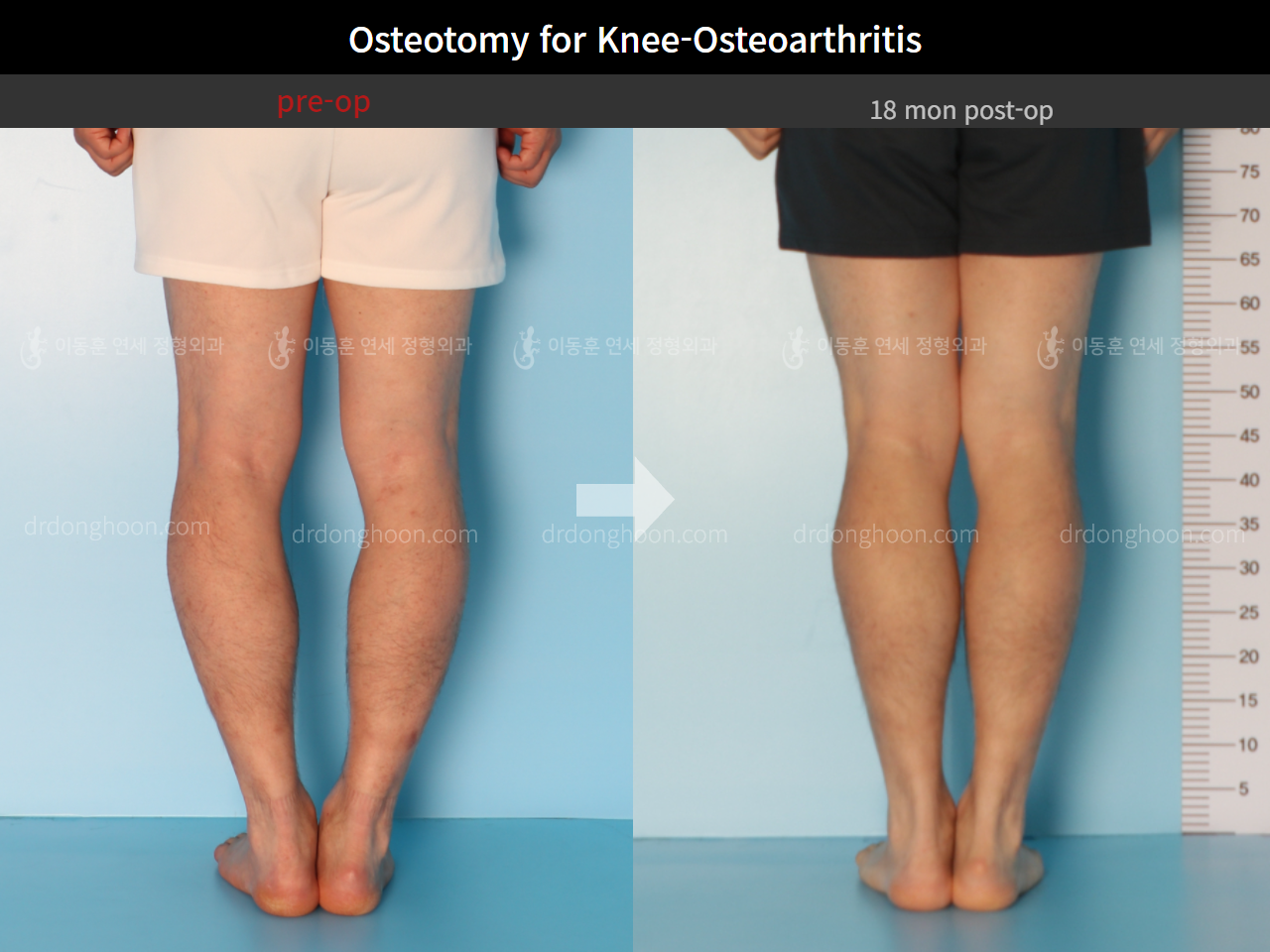 Before and after osteotomy for knee osteoarthritis, case 5394670, image 4, Dr. Donghoon institute (DALRI)