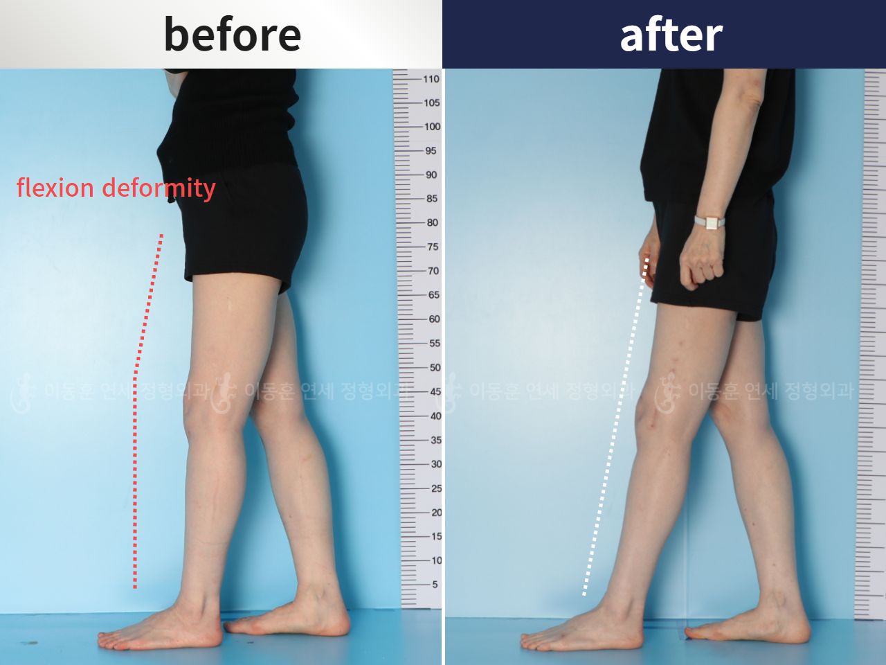 Before and after adult bowlegs, case 5987521, image 2, Dr. Donghoon institute (DALRI)