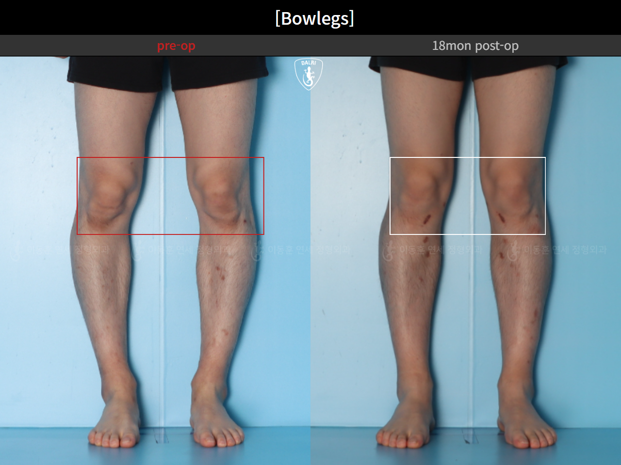 Before and after adult bowlegs, case 94769040, image 10, Dr. Donghoon institute (DALRI)