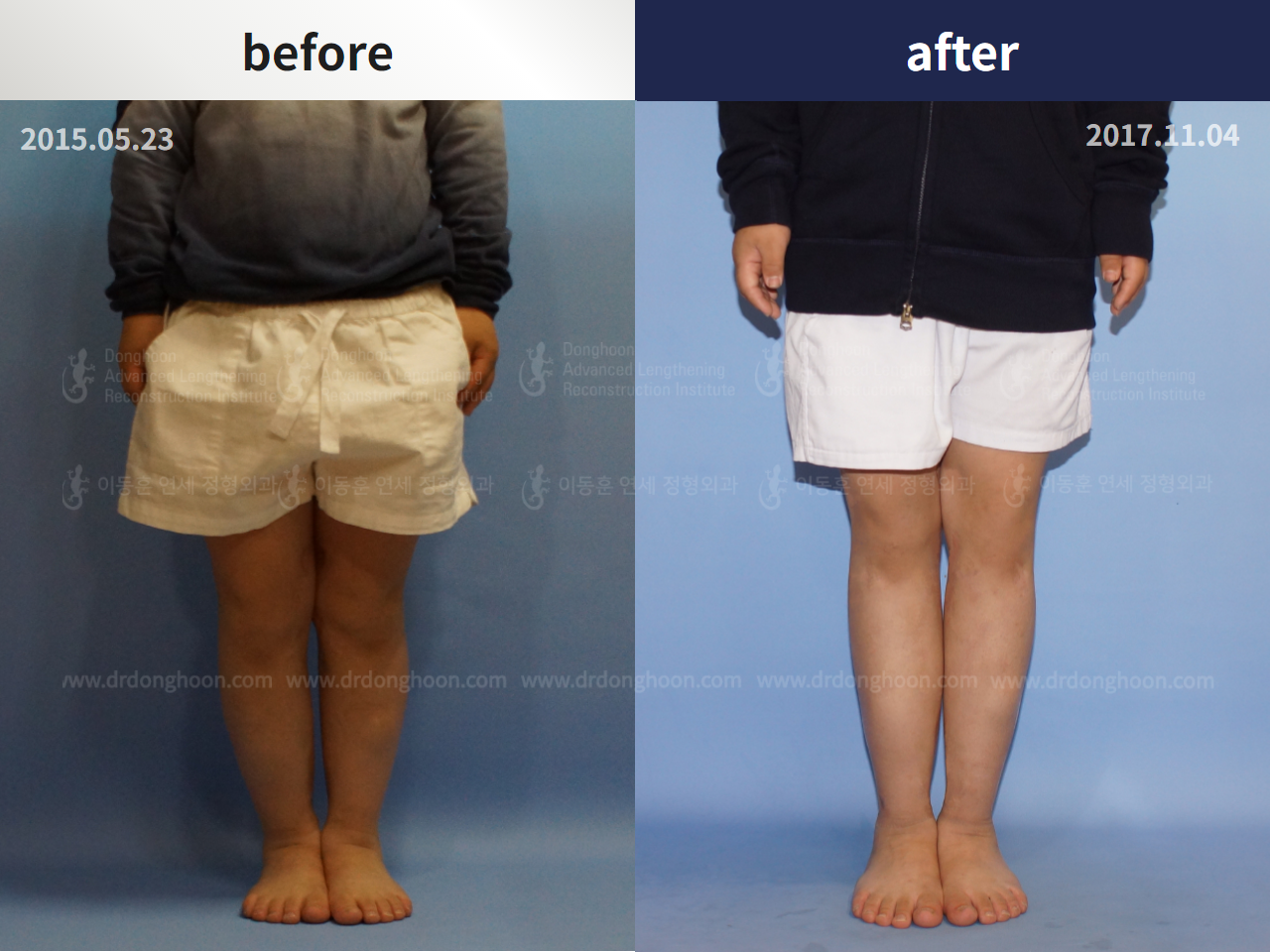 Before and after paediatric congenital condition, case 4304775, image 1, Dr. Donghoon institute (DALRI)