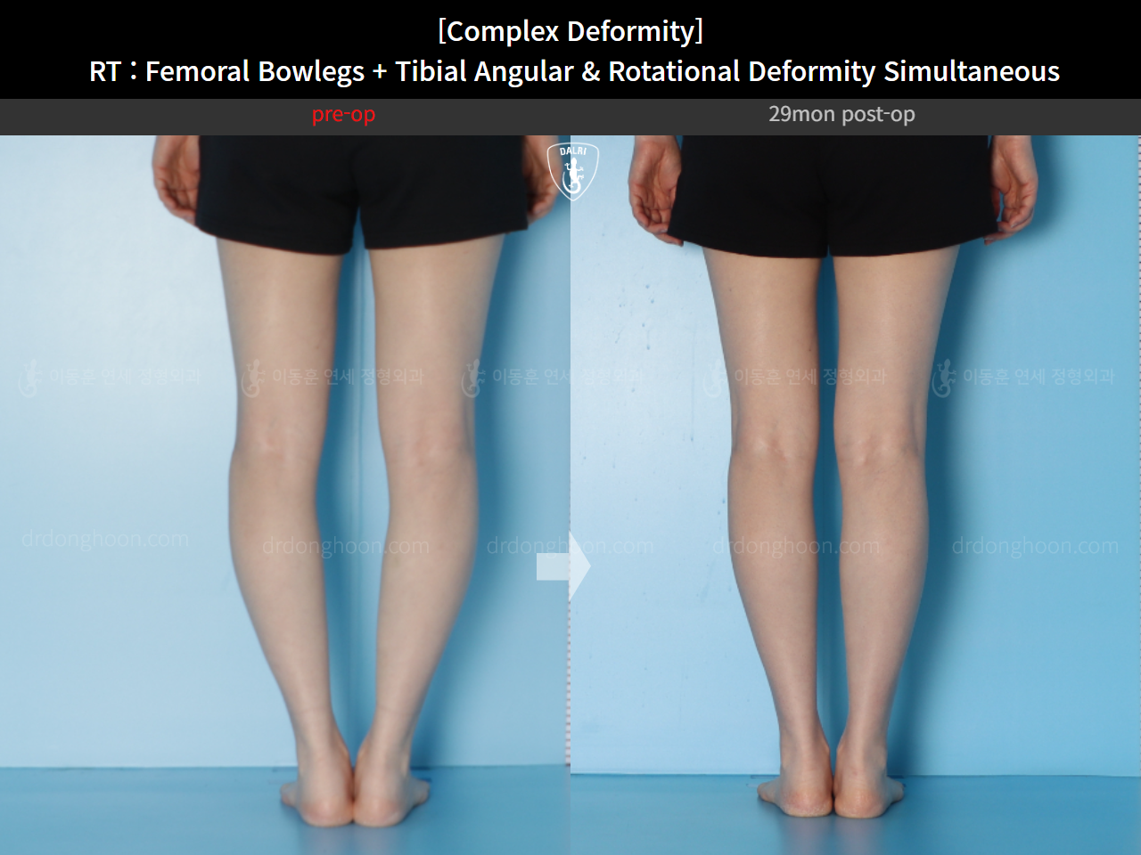 Before and after adult bowlegs, case 14771490, image 9, Dr. Donghoon institute (DALRI)