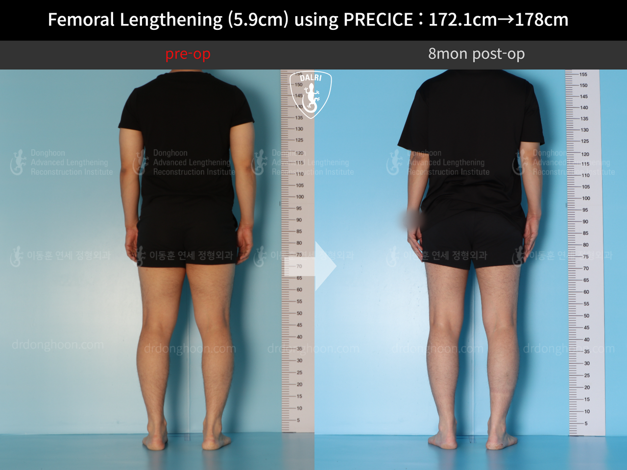 Before and after cll precice, case 13848850, image 3, Dr. Donghoon institute (DALRI)