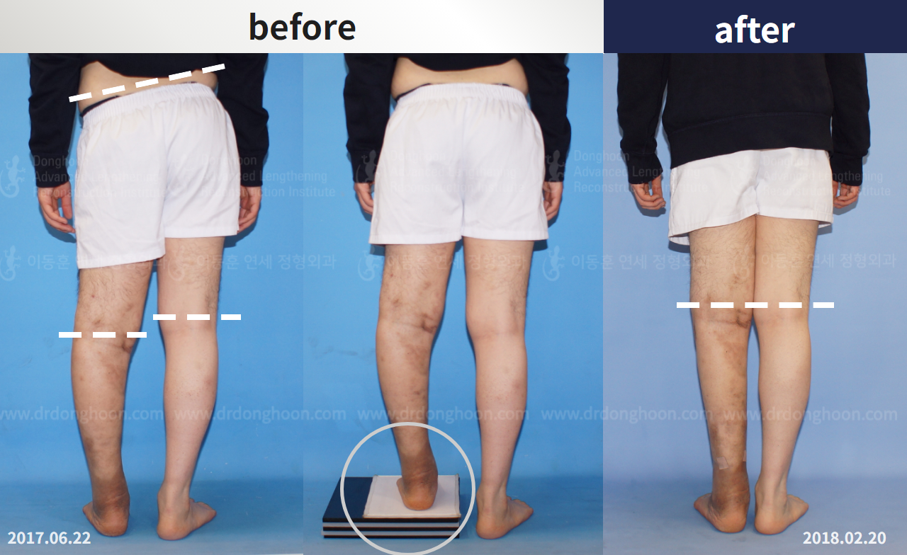 Before and after post-trauma deformity, case 4361765, image 3, Dr. Donghoon institute (DALRI)