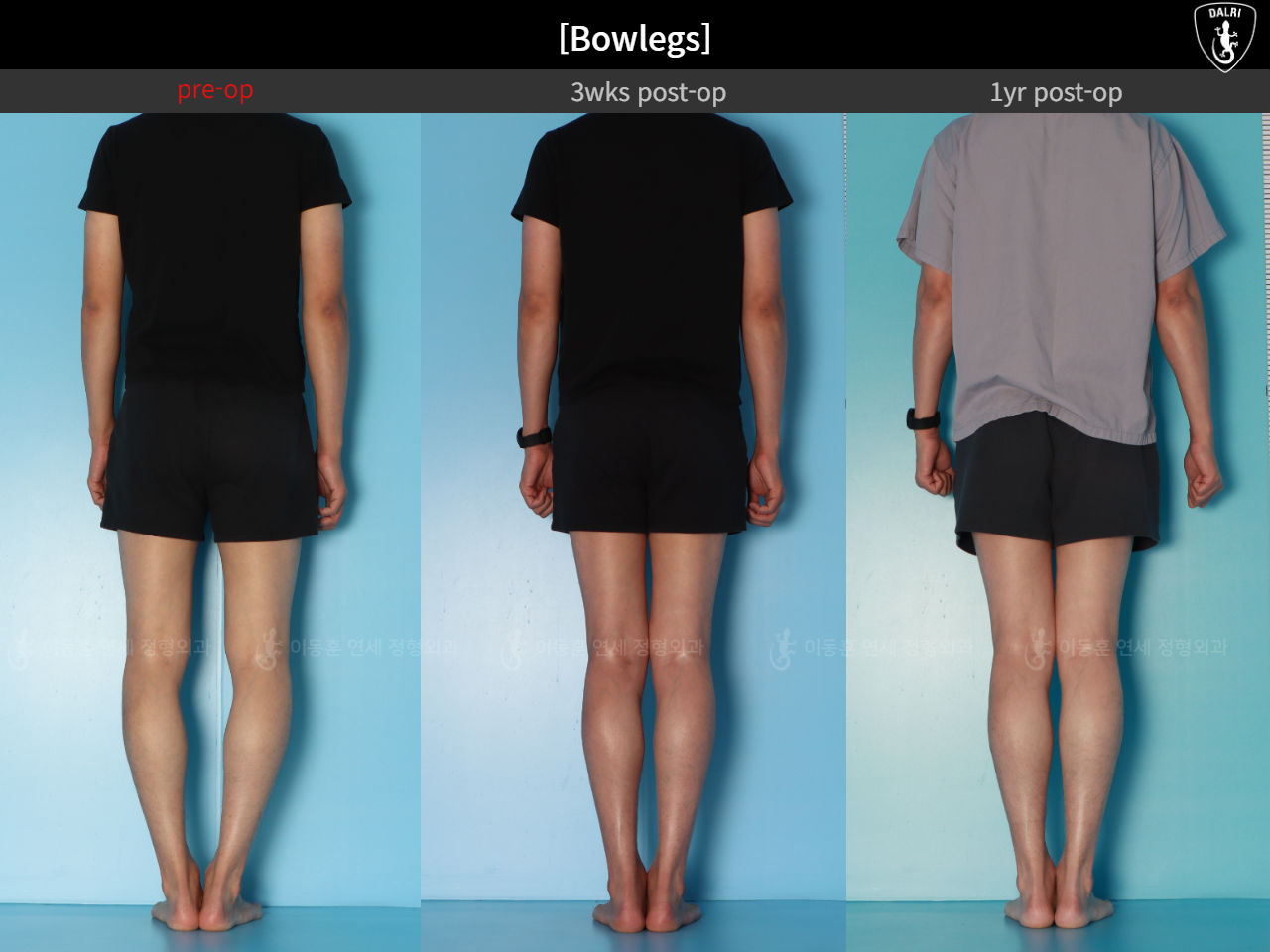 Before and after adult bowlegs, case 32564251, image 4, Dr. Donghoon institute (DALRI)