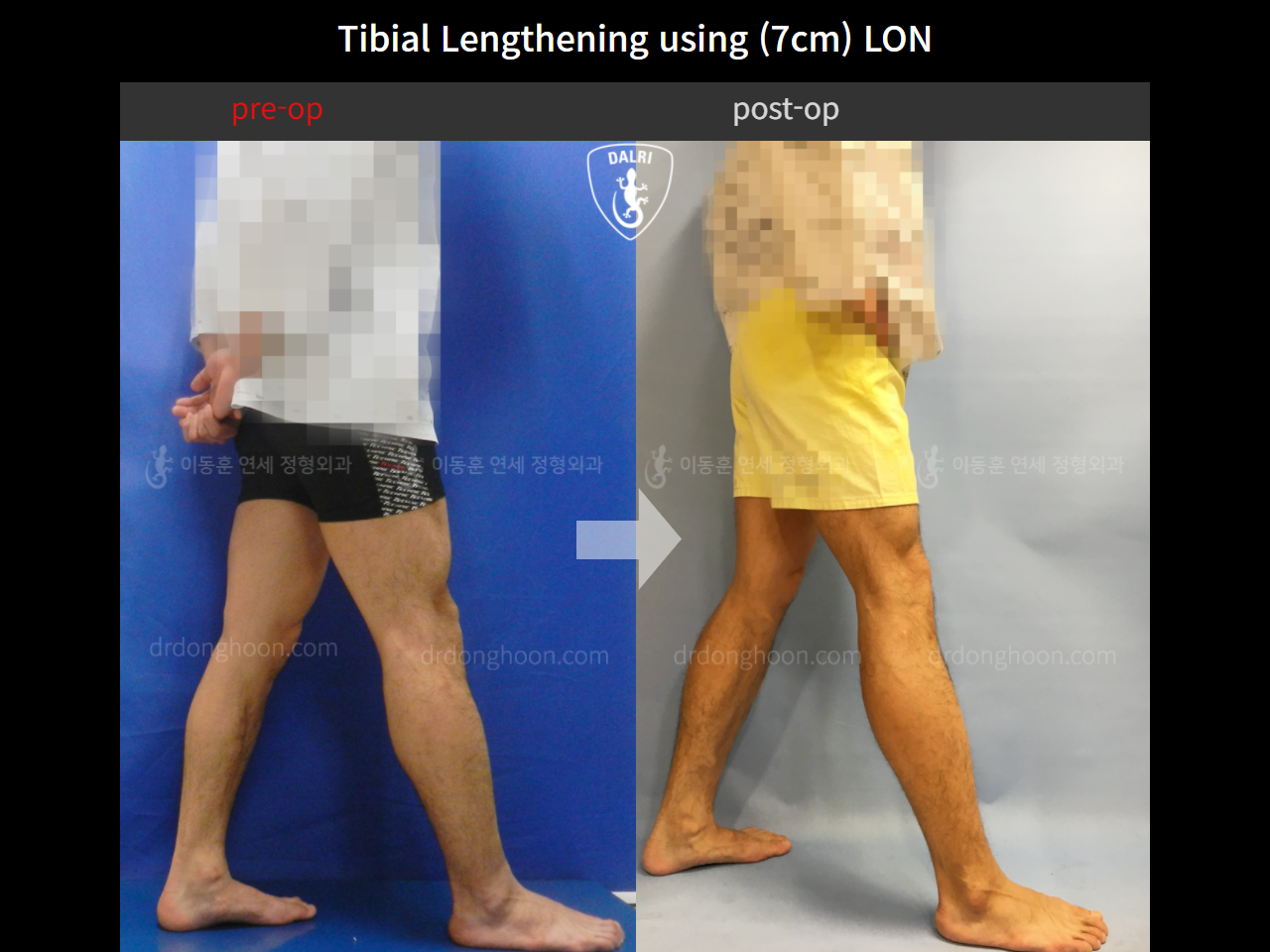 Before and after cll lon, case 4323479, image 3, Dr. Donghoon institute (DALRI)