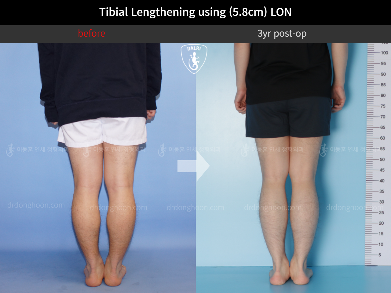 Before and after cll lon, case 10336887, image 6, Dr. Donghoon institute (DALRI)
