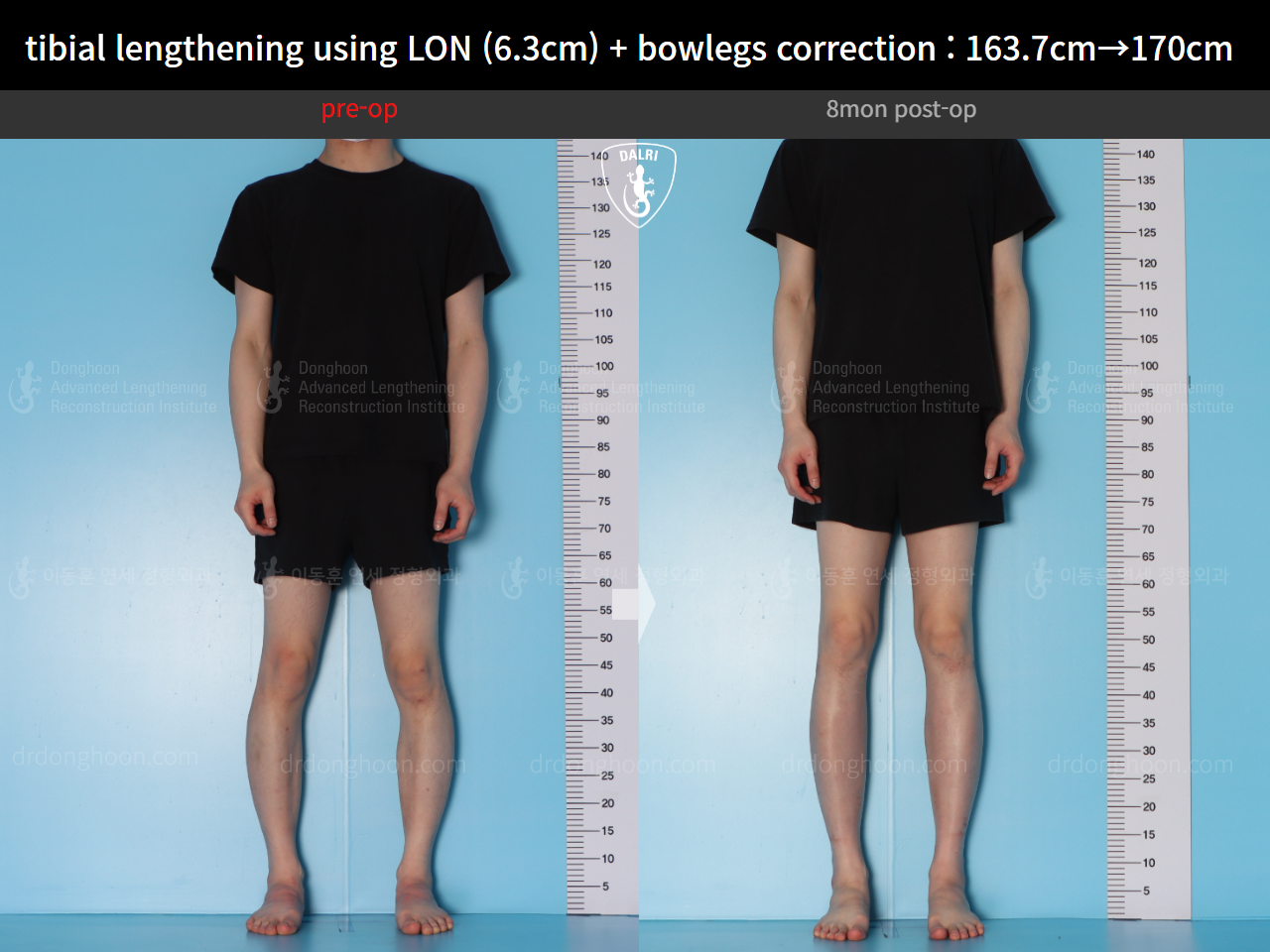 Before and after cll + deformity correction, case 16853829, image 2, Dr. Donghoon institute (DALRI)