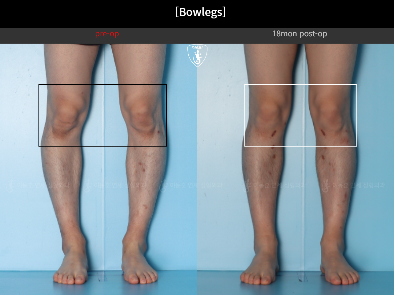 Before and after adult bowlegs, case 124254182, image 8, Dr. Donghoon institute (DALRI)
