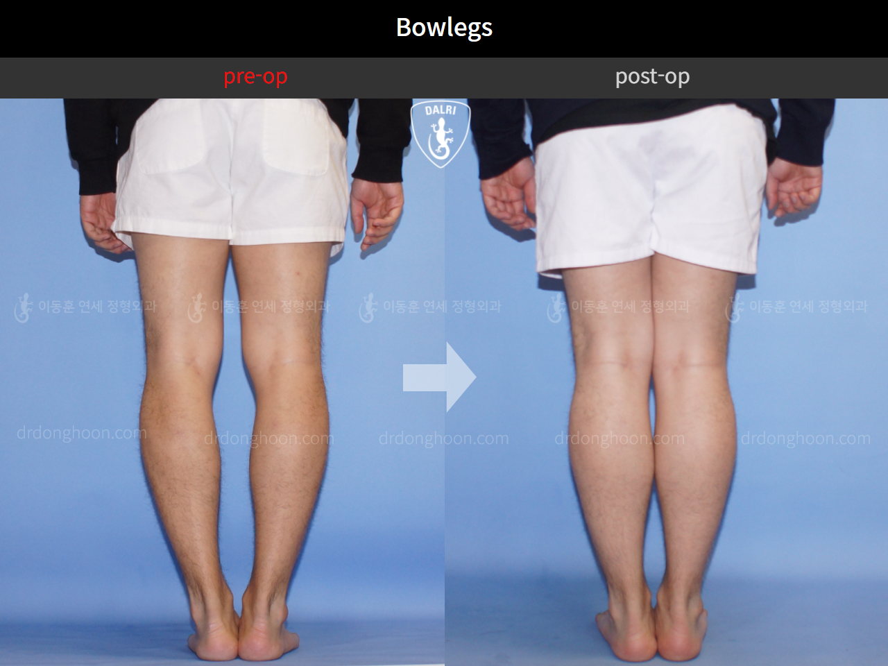 Before and after adult bowlegs, case 10628993, image 4, Dr. Donghoon institute (DALRI)