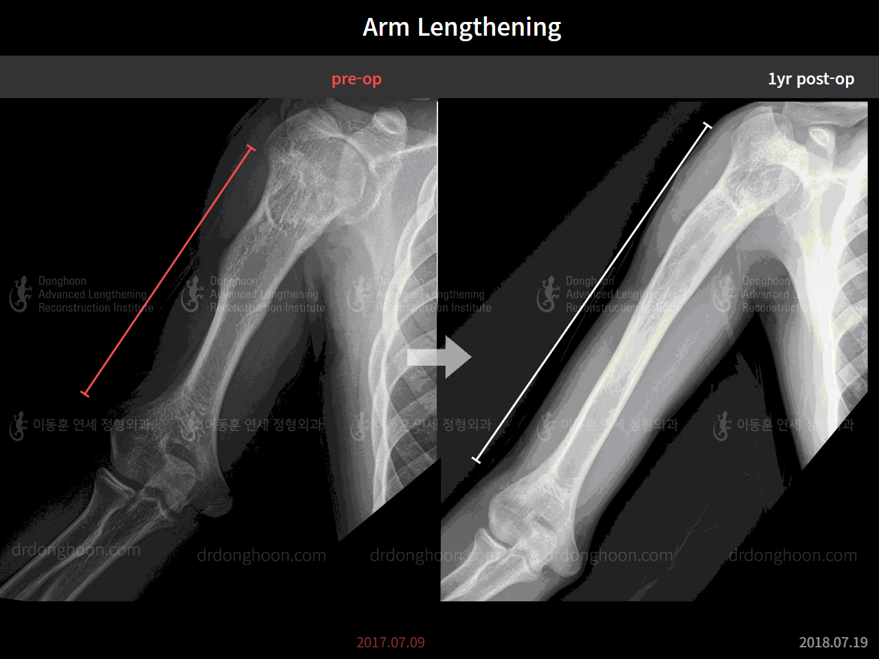 Before and after adult lld, case 8482519, image 3, Dr. Donghoon institute (DALRI)