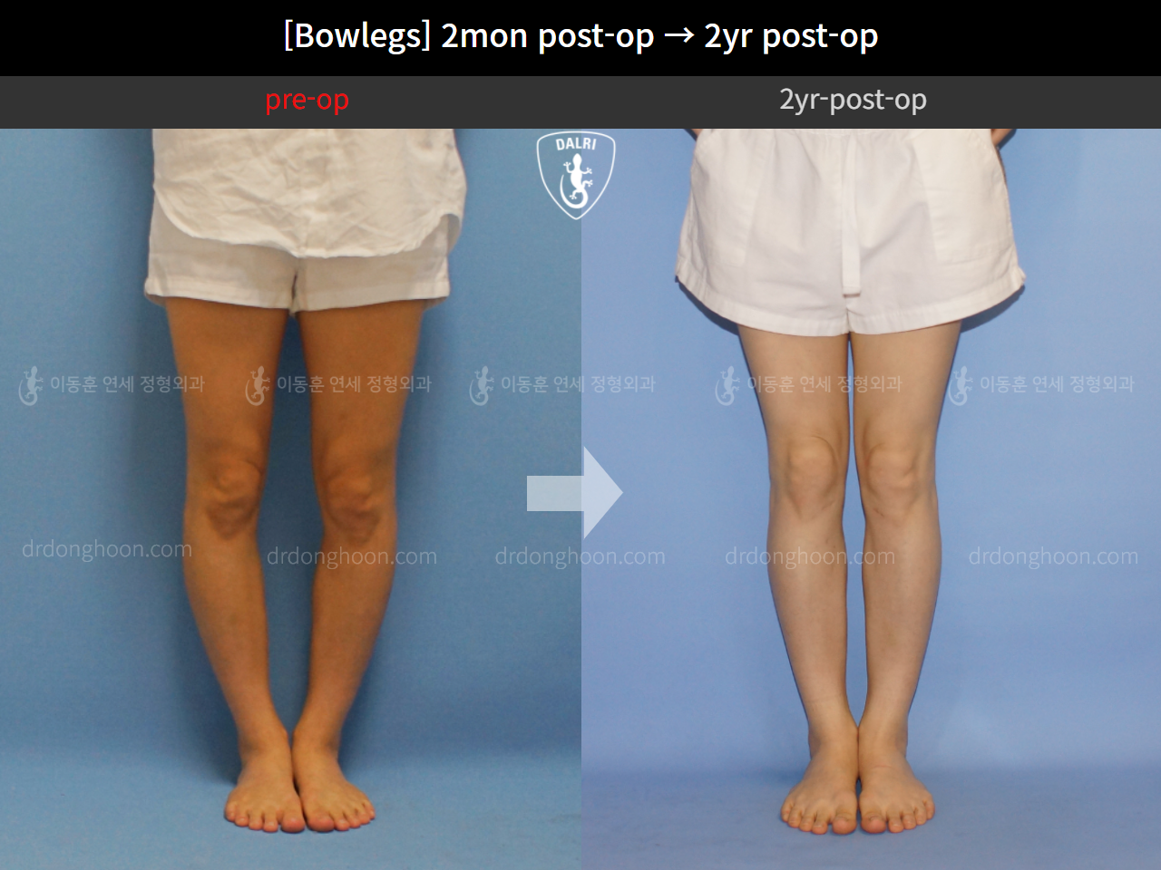 Before and after adult bowlegs, case 4311373, image 5, Dr. Donghoon institute (DALRI)