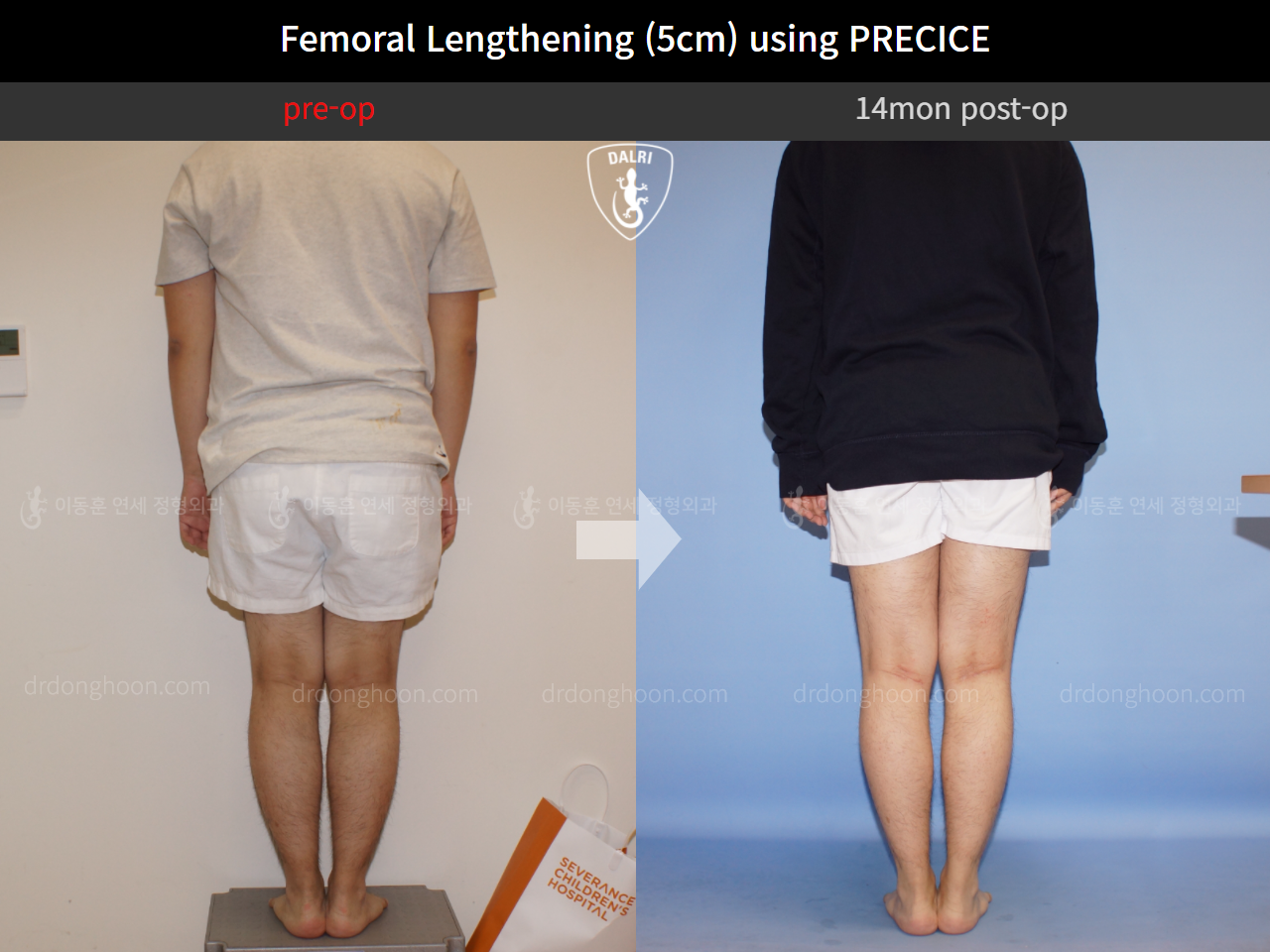 Before and after cll precice, case 4323249, image 2, Dr. Donghoon institute (DALRI)