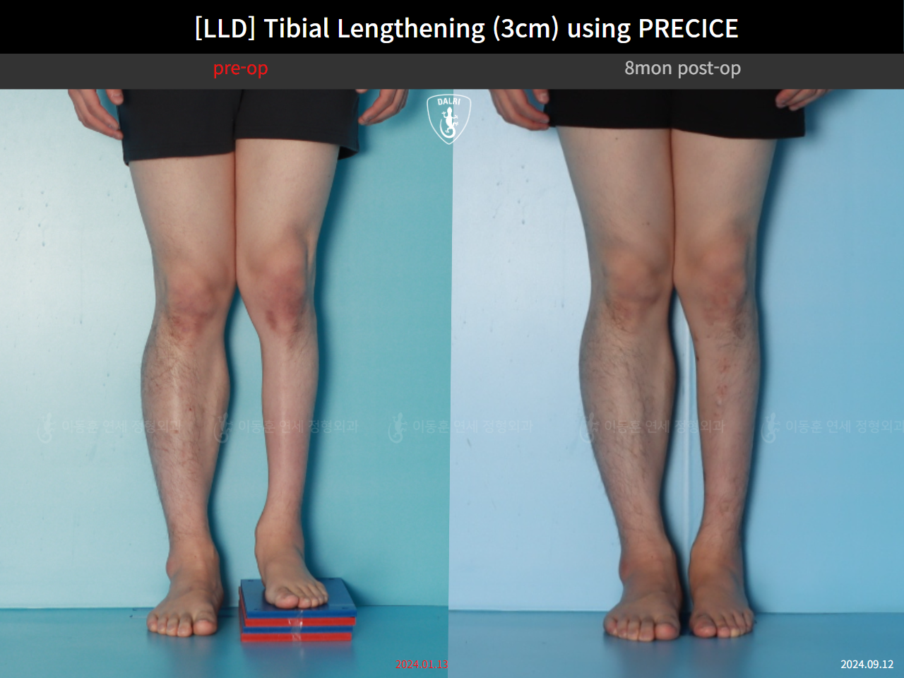 Before and after adult lld, case 124813877, image 5, Dr. Donghoon institute (DALRI)