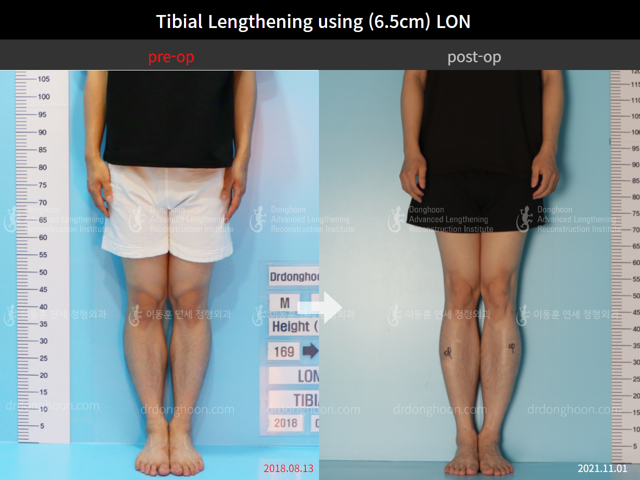 Before and after cll lon, case 8777040, image 5, Dr. Donghoon institute (DALRI)