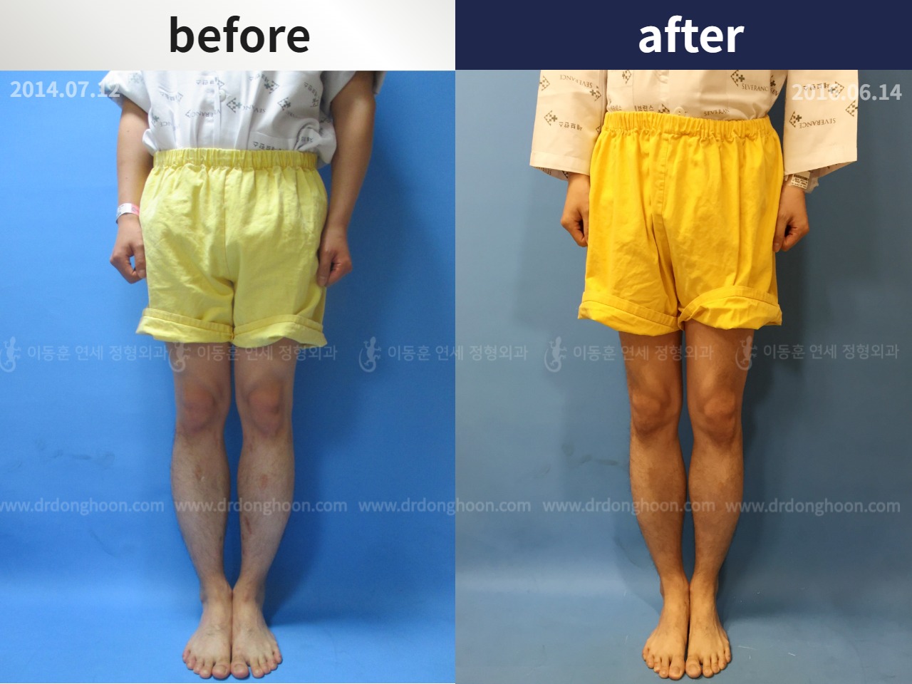 Before and after cll precice, case 4323389, image 1, Dr. Donghoon institute (DALRI)