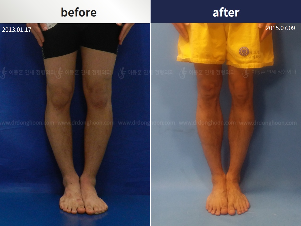 Before and after cll + deformity correction, case 4323105, image 1, Dr. Donghoon institute (DALRI)