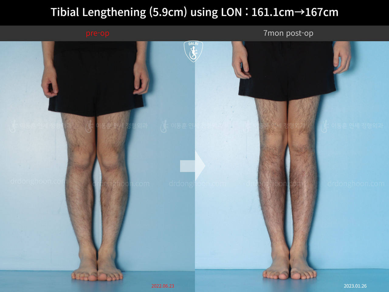 Before and after cll lon, case 14064750, image 6, Dr. Donghoon institute (DALRI)