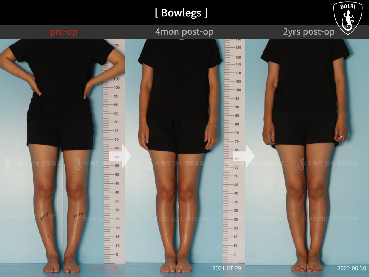 Before and after adult bowlegs, case 12060396, image 1, Dr. Donghoon institute (DALRI)