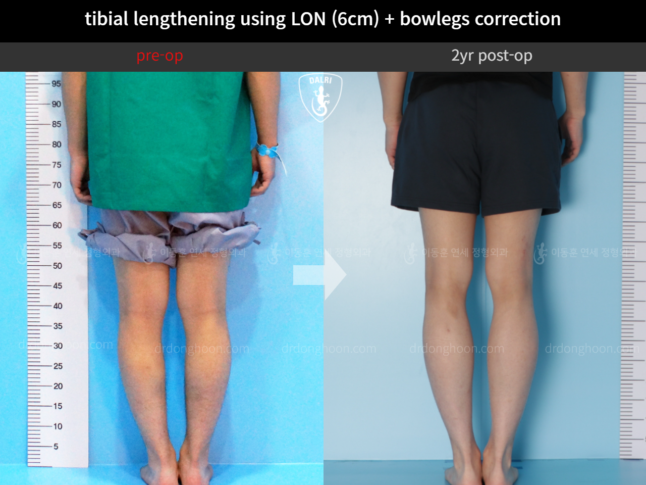 Before and after cll + deformity correction, case 4323141, image 6, Dr. Donghoon institute (DALRI)
