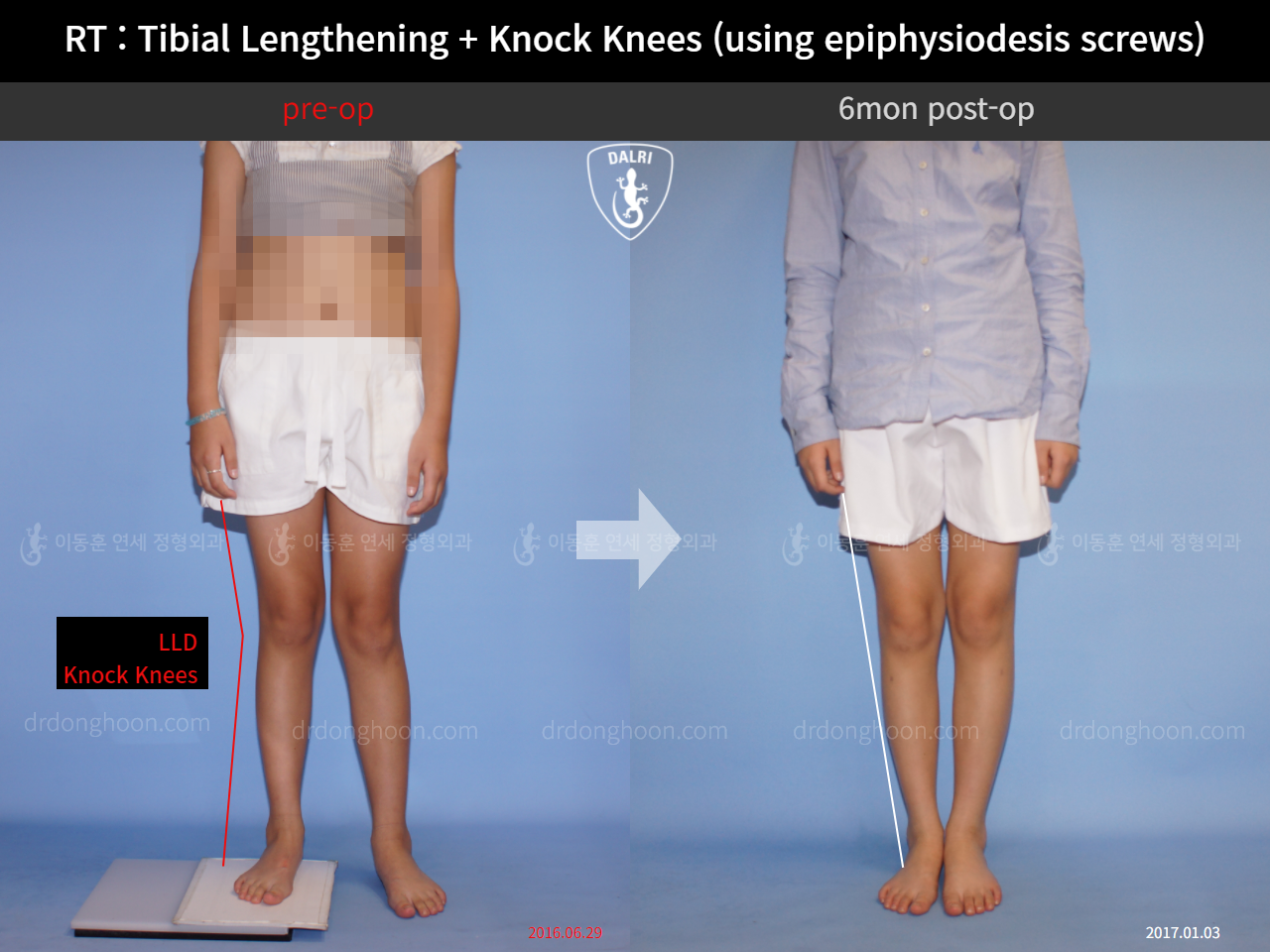 Before and after paediatric & adolescent lld, case 4320397, image 1, Dr. Donghoon institute (DALRI)