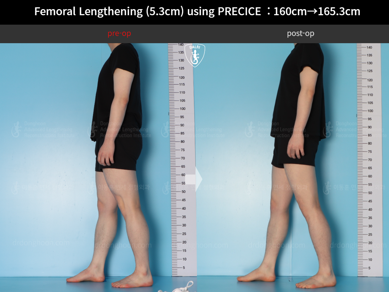 Before and after cll precice, case 18250566, image 6, Dr. Donghoon institute (DALRI)