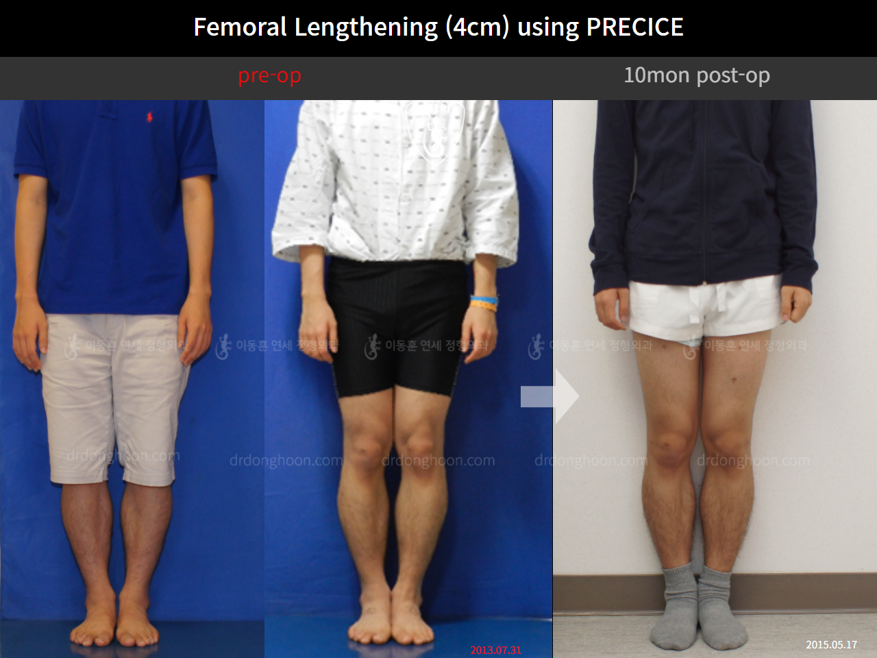 Before and after cll precice, case 4323369, image 1, Dr. Donghoon institute (DALRI)