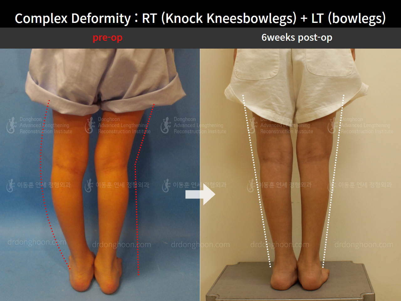 Before and after paediatric & adolescent knock knees, case 8618314, image 3, Dr. Donghoon institute (DALRI)