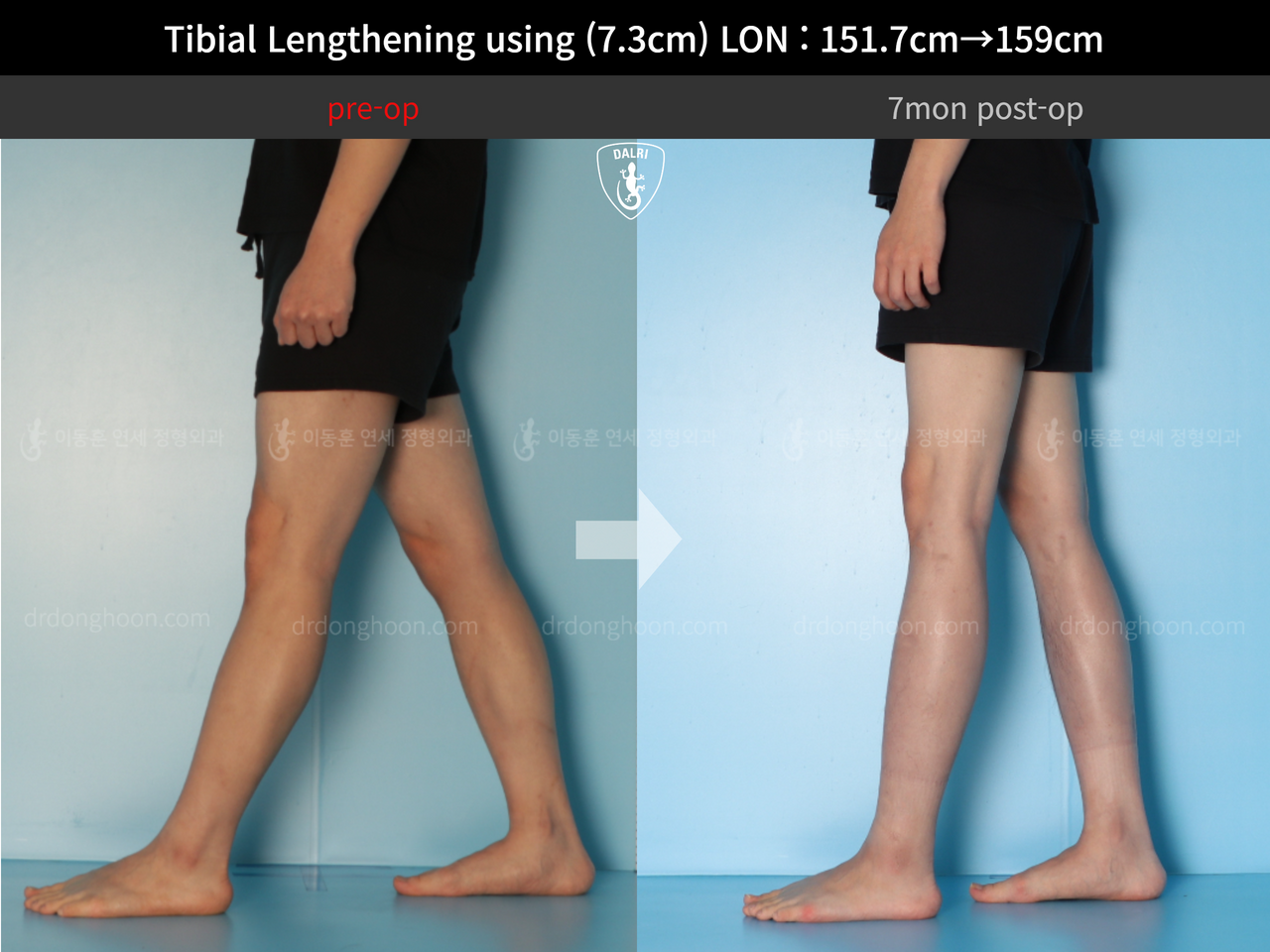 Before and after cll lon, case 13119336, image 8, Dr. Donghoon institute (DALRI)